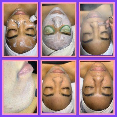 Microdermabrasion Facial