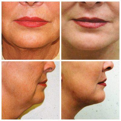 Liposuction and Face Lift