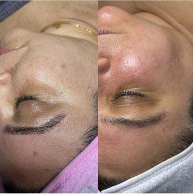 Treating hyperpigmentation with a monthly chemical peel