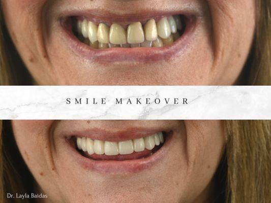 Smile Makeover