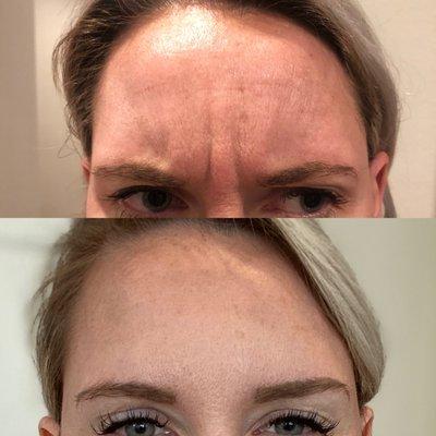 Botox Before & After Glabella or "eleven lines"