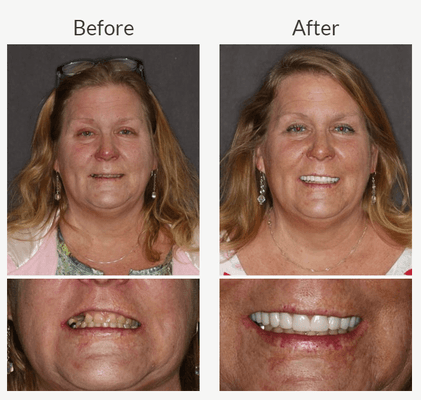 Dr. Reeves performed a smile makeover and was able to save her teeth!