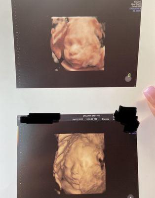 3D/4D ultrasound at 28 weeks