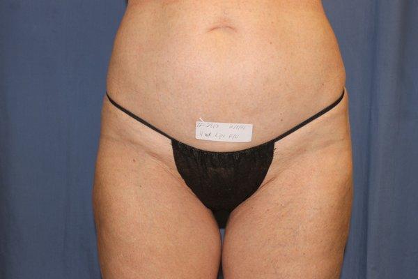 After Laser Lipo