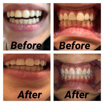 Teeth whitening for a teenager before and after