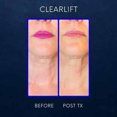 Clear Lift Neck!