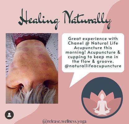 Cupping with Natural Life Acu