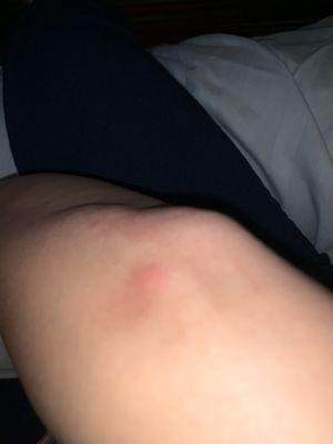 Bed bug bite