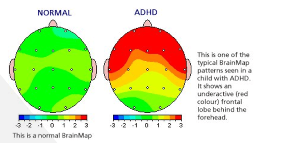 reatment begins with comprehensive Brain Mapping that identifies regions of the Brain that can benefit from recieving feedback. FDA approved