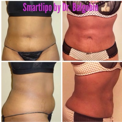 Smartlipo laser liposuction.