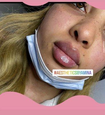 Lips are nurse Amy ultimate fav to do every lip is different and needs expert eye for art and aesthetic to bring out the beauty of each lip