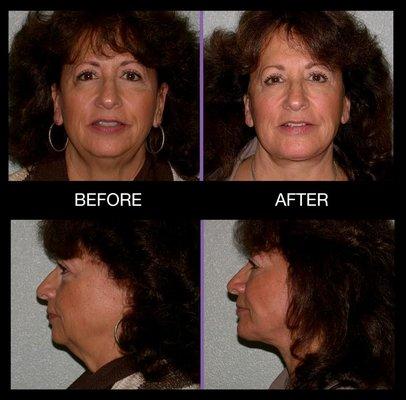 56-years-old patient. 19 months post-op. Lower face lift, chin implant, fat injections- brow & lower.