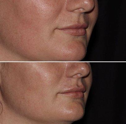 Lip filler treatment using Volbella, by Elizabeth B., RN