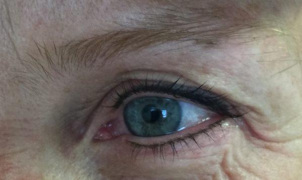 After permanent eyeliner procedure