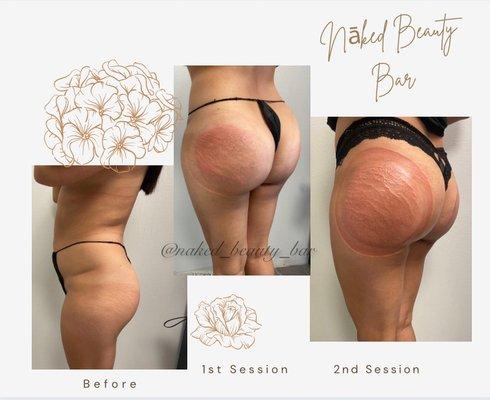 Natural Non Invasive BBL 

Natural Butt Enhancements some with VacuumTherapy