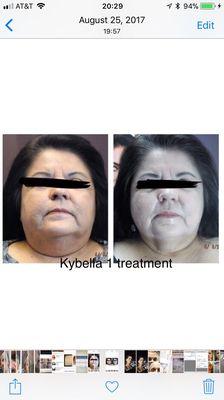 Kybella for submental fat,double chin- permanent removal