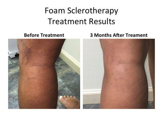 Before and After Treatment for Veins