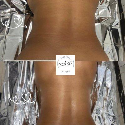 Before and After  Her first session Metal Therapy Benefits *Slims the body *Reduces inflammation *Lymphatic drainage *Tones and Tightens