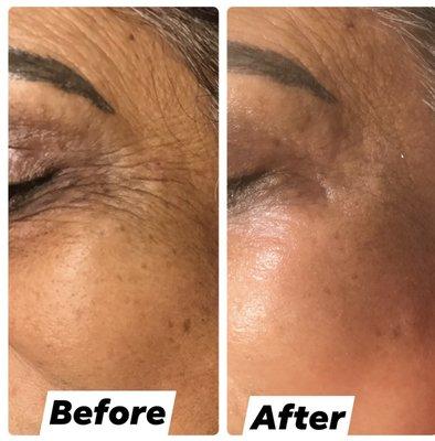 Fine lines and wrinkles treatments