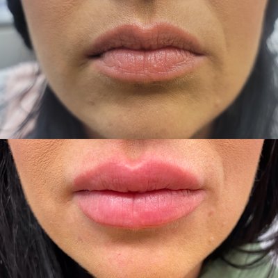 Before and after lip filler