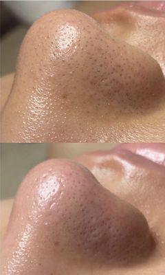 Blackhead Removal