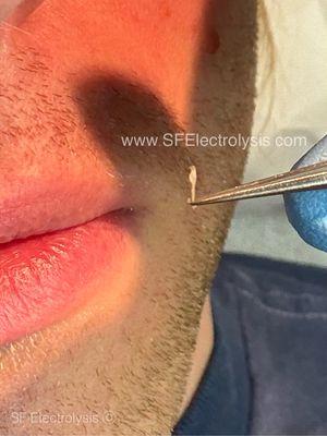 Effective permanent removal of course facial hair.