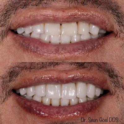 Before and after of natural porcelain veneers