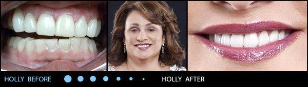 Holly's before & after at Scottsdale Dental Arts!