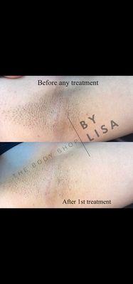 Underarm Skin Color Correction