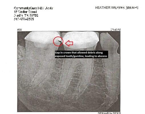 This is the tooth referred to in my review, circle is the side portion of the gap between the crown/gums.