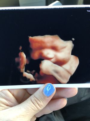 Ultrasound photo