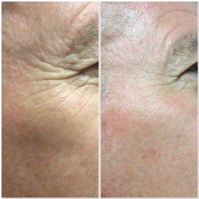 Alma™ non-ablative ClearLift resurfacing treatment Improve skin texture' Smooth fine lines Decrease melasma