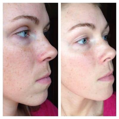 Peel lightening for discoloration and hyper pigmentation