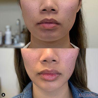 Lip + Chin Filler