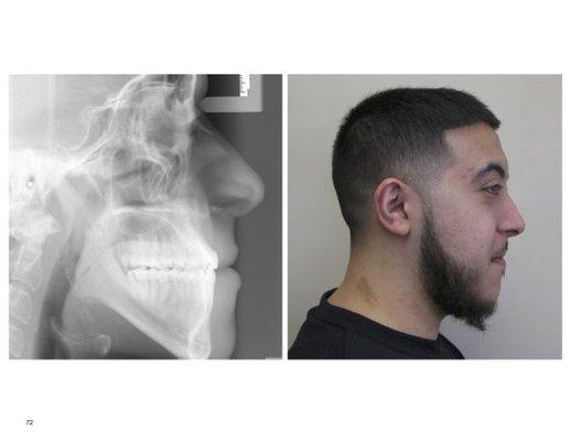 Skeletal Class III - Adult 'Underbite' After Braces ***NO SURGERY***