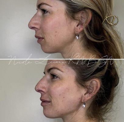 And this is how you achieve full facial balance with filler.