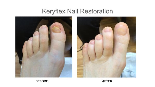 One of our patients came in with an incomplete nail, and walked out with a new nail and ready for the beach!