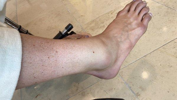 Several hours after breaking my ankle.