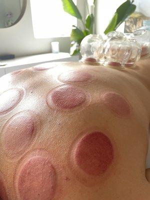 cupping