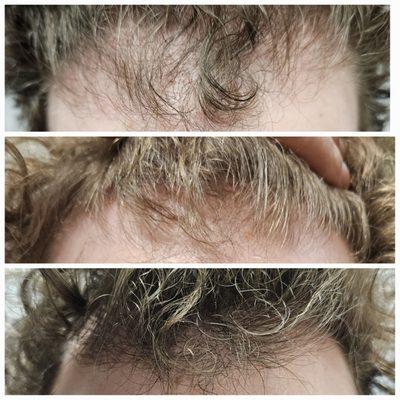 Platelet-rich fibrin (PRF) hair restoration a non-surgical, minimally invasive treatment that stimulates hair growth