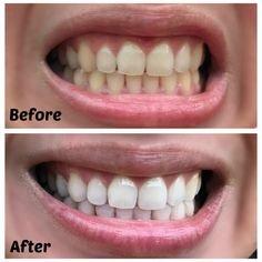 Brighten teeth up to 6 shades in one session.