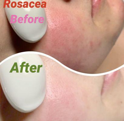 One of my specialty to treat! Rosacea