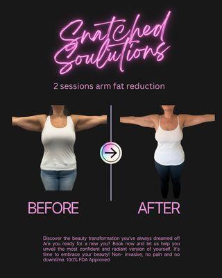 Arm fat reduction