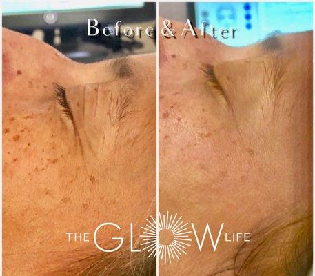 Before & After HydraFacial with connective tissue growth factor booster.