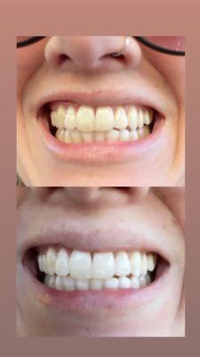 Glorious Smile Natural Teeth Whitening