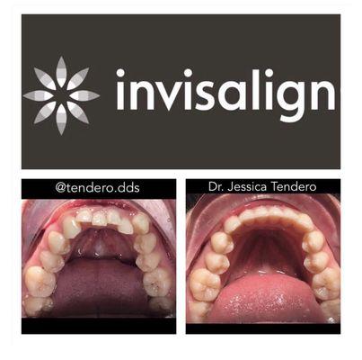 Invisalign - Before & After