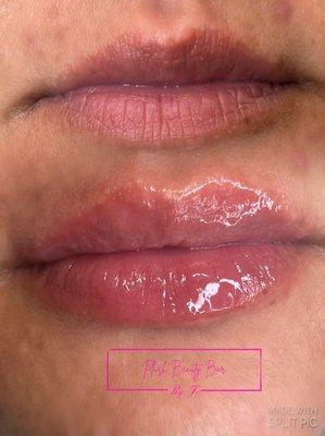 No Needle Lip filler!
Minimal to no pain at all
Instant results
Last up to 6 months