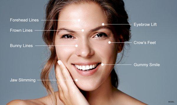 Botox can be used in many different areas.