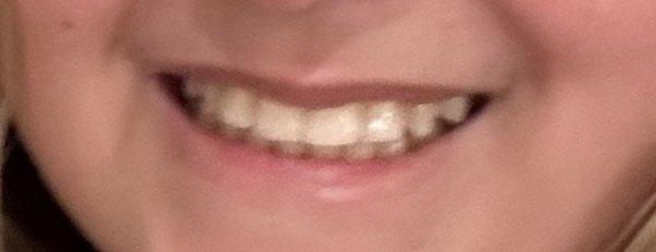 This is my teeth after the orthodontist reshaped without consent and destroyed my smile and my two front teeth