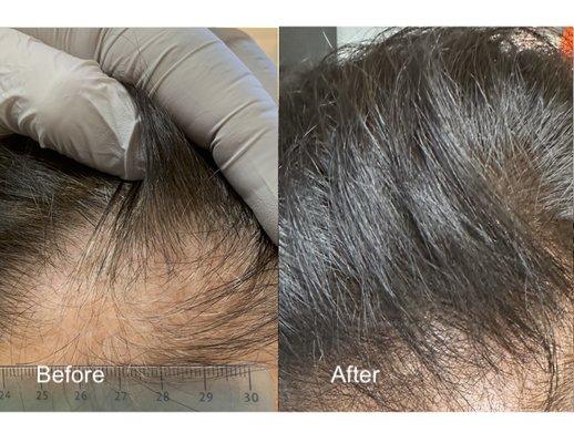 Our women's hair regrowth team has over 15 years of regenerative experience in PBC hair restoration...